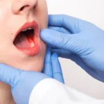 Lifestyle tips to Avoid Oral Cancer in Ahmedabad