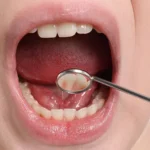 Mouth Cancer in Ahmedabad: Why Location Inside Your Mouth Changes Everything