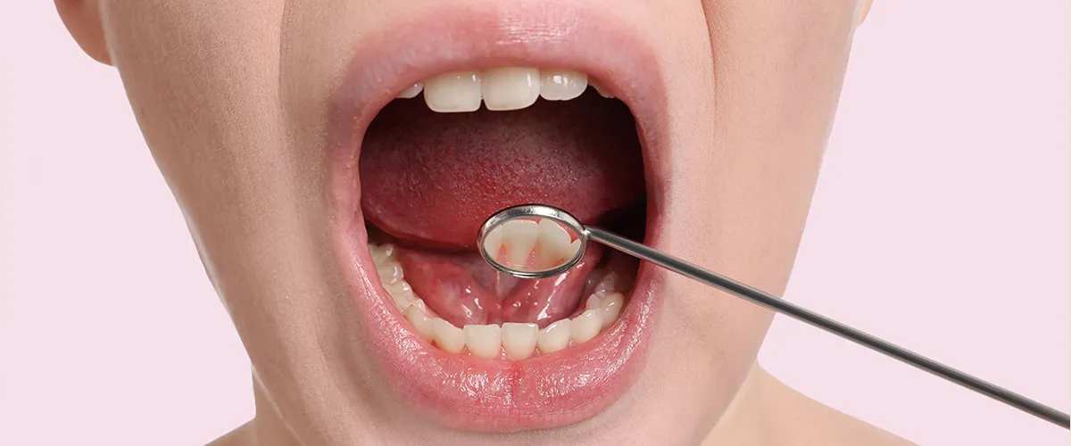 Mouth Cancer in Ahmedabad: Why Location Inside Your Mouth Changes Everything