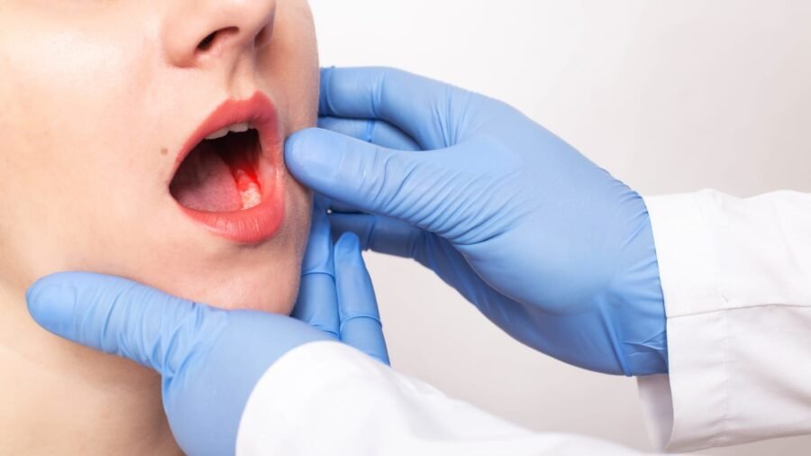 Before It Becomes Oral Cancer in Ahmedabad: Precancerous Conditions You Shouldn’t Ignore